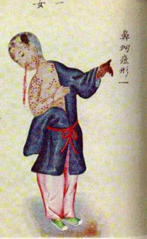 Late 11th Century AD: Smallpox Inoculation
