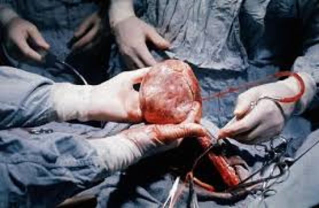 Heart Transplant