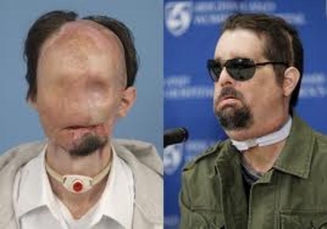 Face Transplant