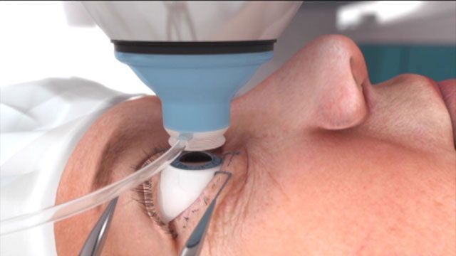 Laser cataract surgery