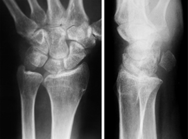 Yo me rompí un muñeca.