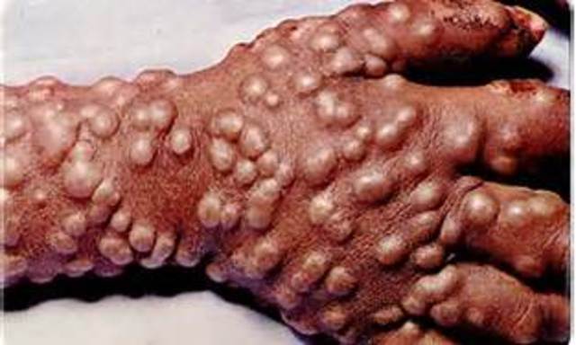 vaccine for small pox