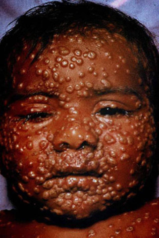 edward jenner found the vaccination for smallpox