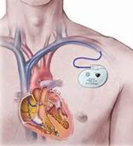cardiac pacemaker