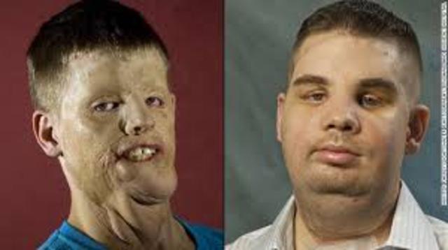 First partial face transplant