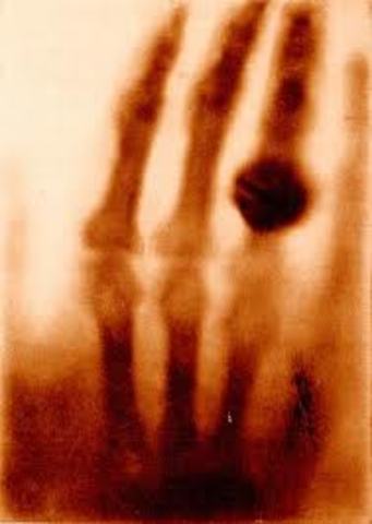 William Roentgen discovered the X-ray