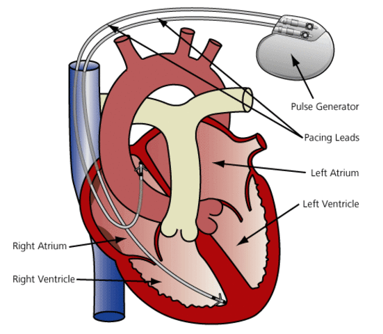 first cardiac pacemaker