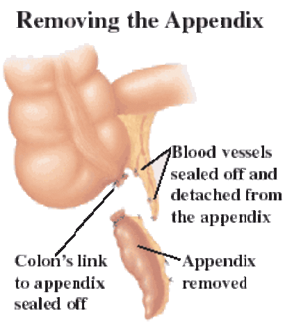 Appendectomy