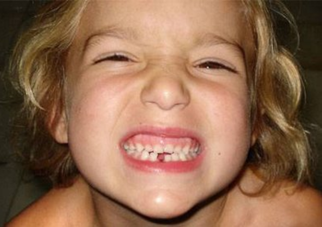 Se cae mi primer diente