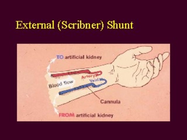 The Development of “Scibner Shunt”