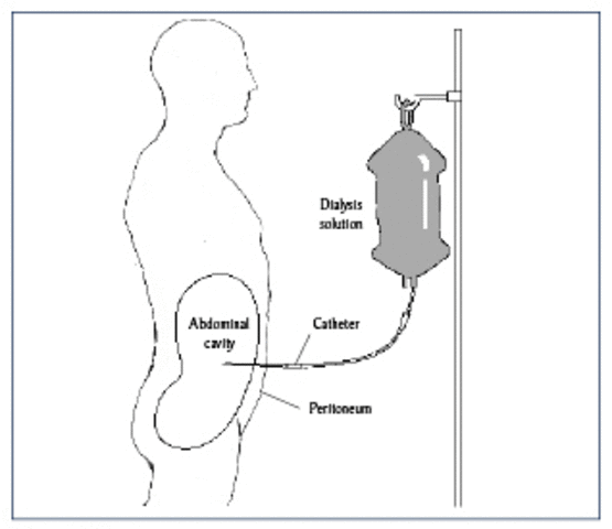 The Concept of Peritoneal Dialysis