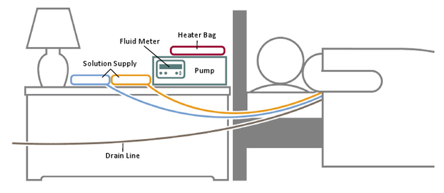 The Continuous Cycling Peritoneal Dialysis (CCPD)