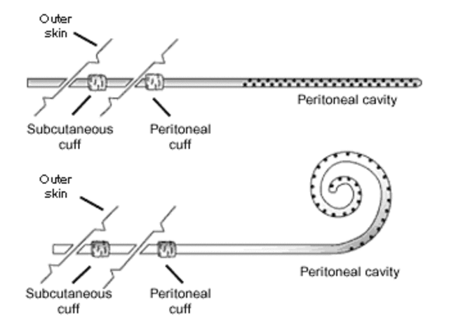 Tenckhoff's silicone catheter