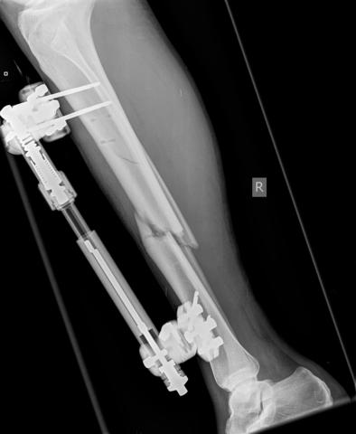 Dad shattered knee & sold bikes.