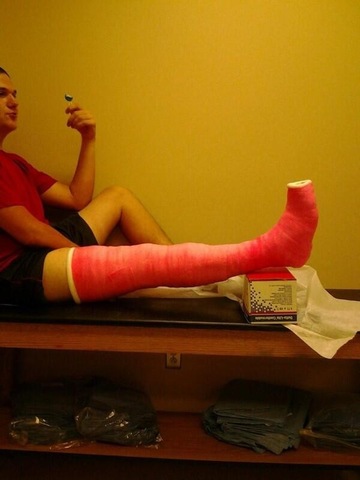 Broken leg
