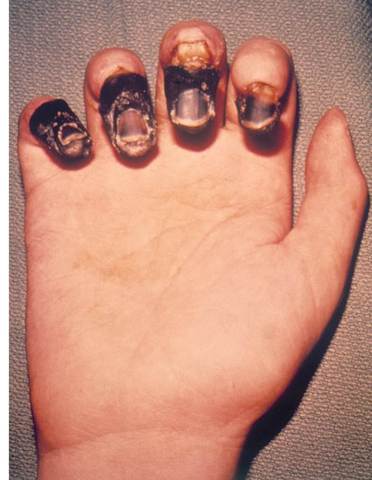 Recurrence of the bubonic plague