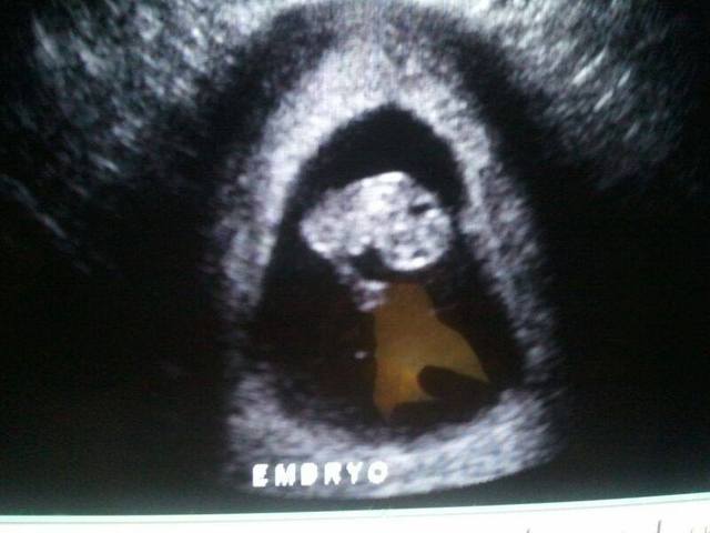 8 semanas de embarazo