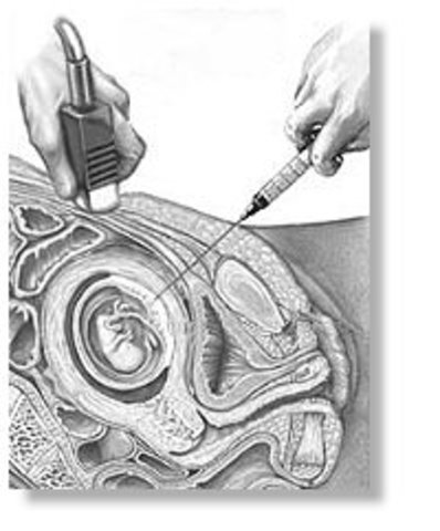 Amniocentesis