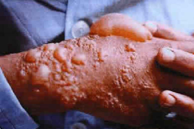 Suposto uso de armas químicas