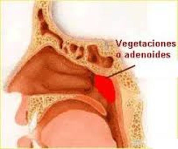 MY TONSYLS OPERATION