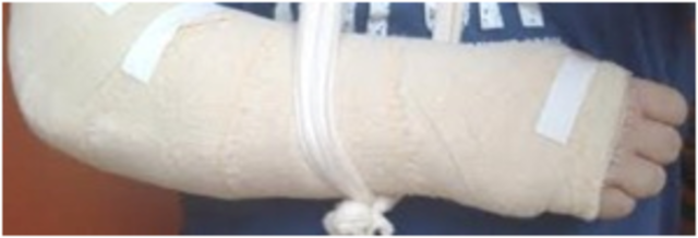 Alexandro - Braço quebrado