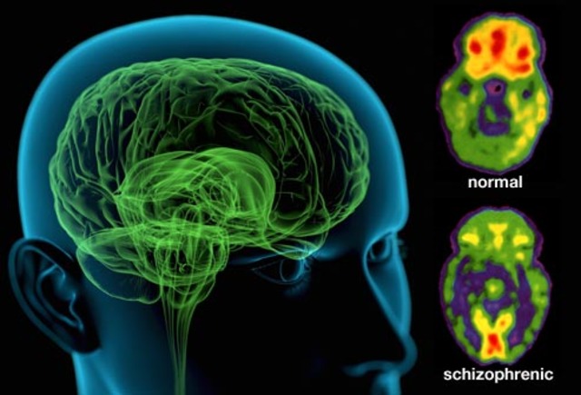 Schizophrenia and Toxoplasmosis