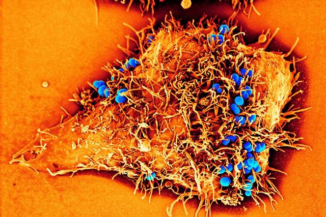 Super Gonorrhea (New Discovery)