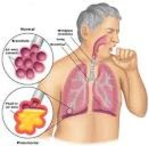 Causes of Pneumonia