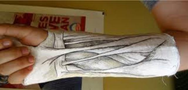 Festa de 10 anos com braço quebrado-Guilherme