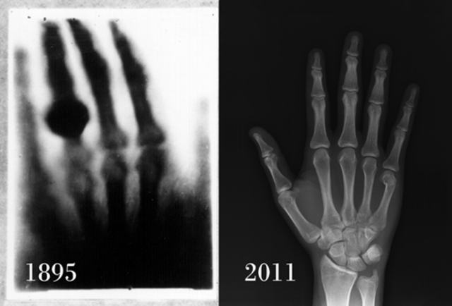 X-Ray Invented