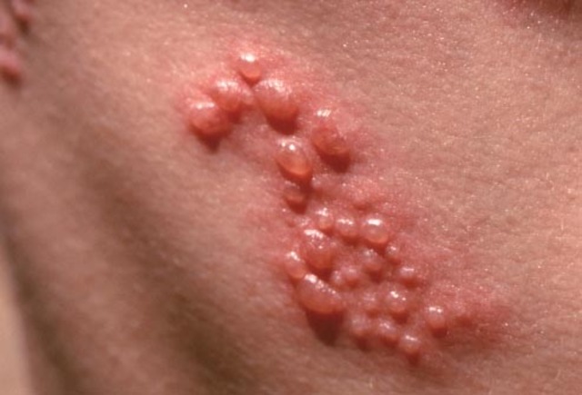 Shingles?