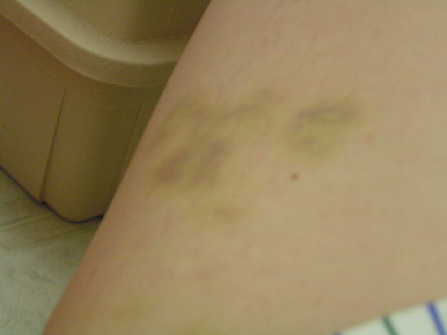 my thighs looked like this