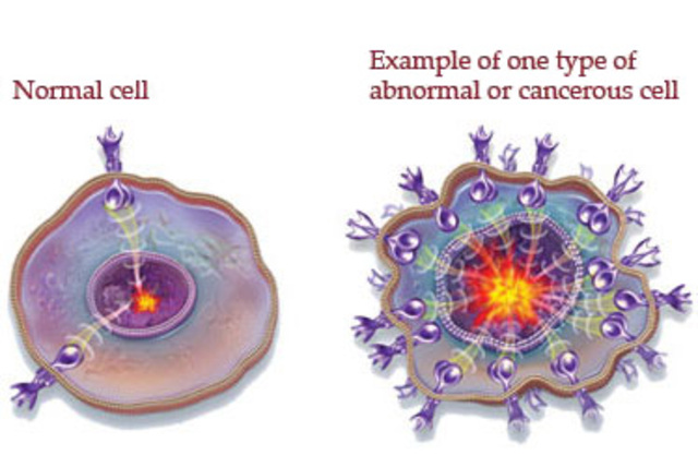 Rudolf Virchow and abnormal cells