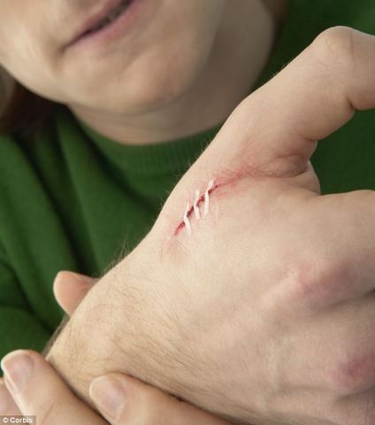 Calabaza lastimó la mano