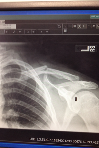 Broke my Collar bone