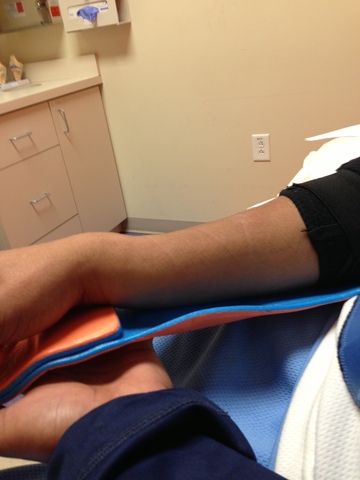 broke my radius and cracked my ulna