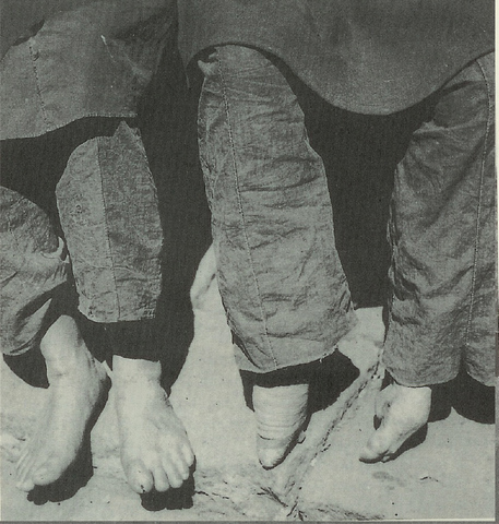 Footbinding