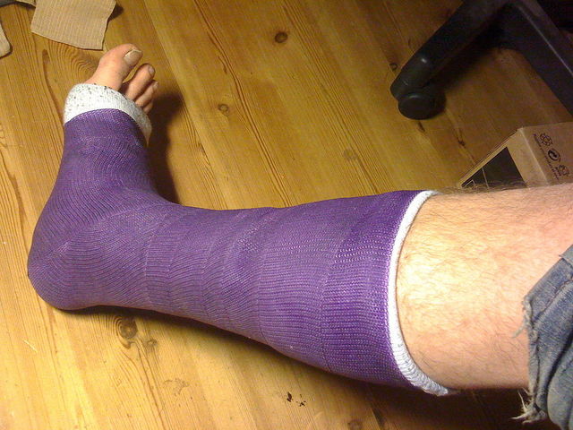 broke my leg playing soccer