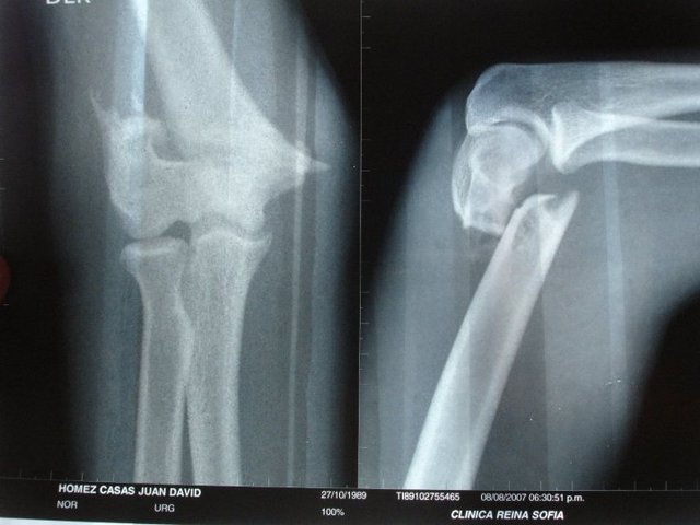 Fractura Humero