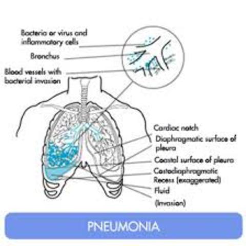 Biosocial: Pneumonia