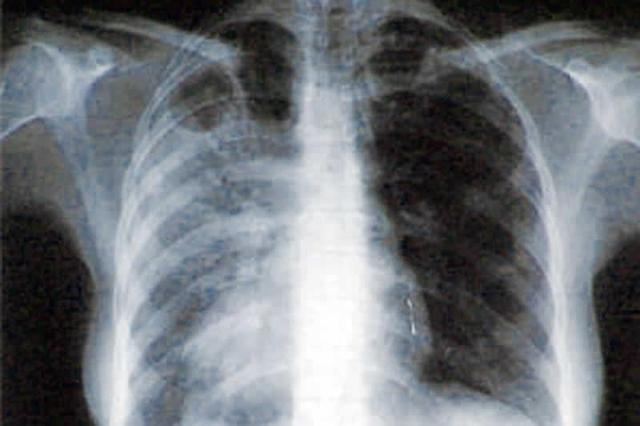 Tuberculosis (E and A)