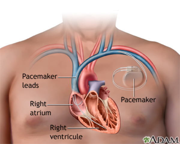 The internal pacemaker invented by Wilson Greatbatch.