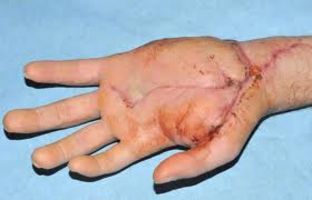 First Hand Transplant (US)