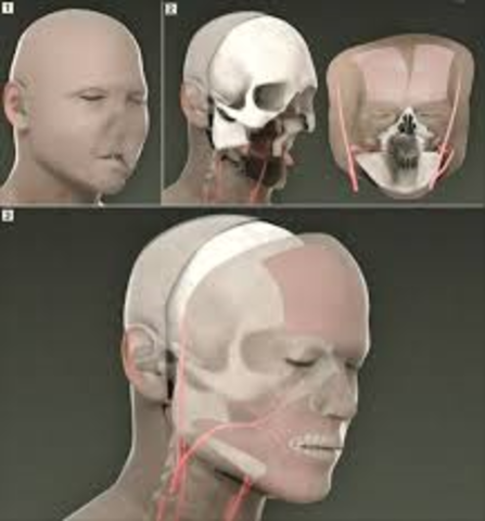 First Successful Partial Face Transplant (France)
