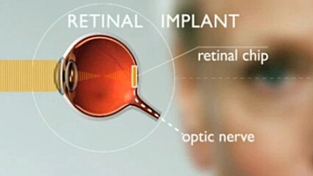 Retinal Implants