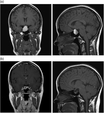 Natali is Diagnosed with Second Tumor