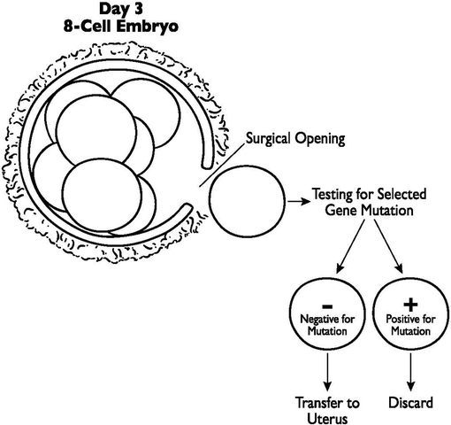 PGD used to determine sex of human embryos, first PGD baby born.