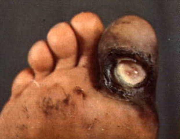 Bubonic Plague In India