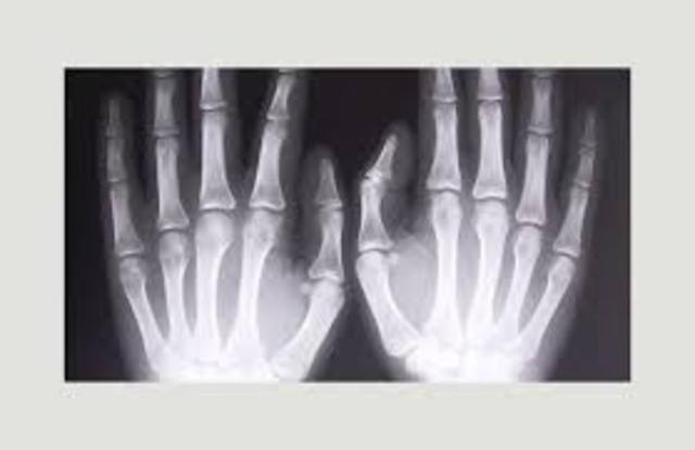 Röntgenkiirte avastamine