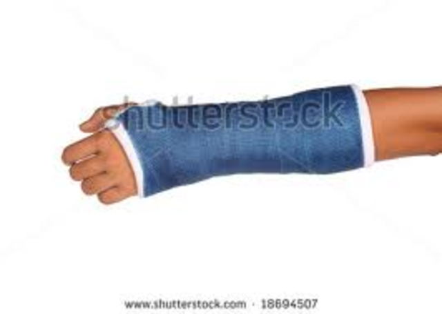Broken Arm